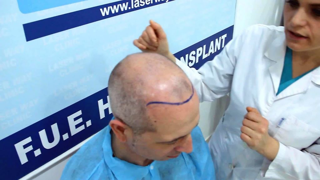 Shaving Your Head for Hair Transplantation