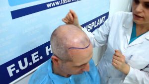Radere la Testa per un Trapianto di Capelli