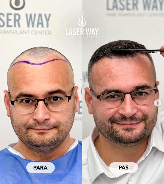 mbjellje floku FUE ne Tirane te Laser way