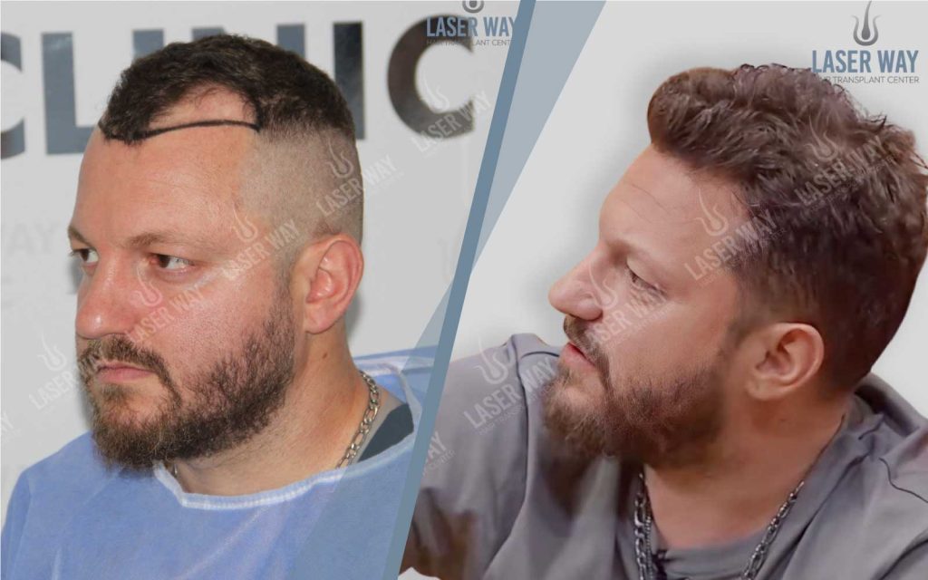 Renis Gjoka Hair Transplant Look Natural