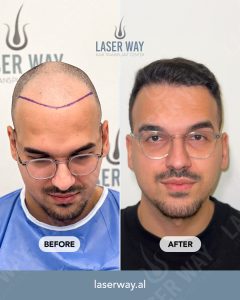 Laser Way Clinic è diventata sinonimo di qualità e affidabilità nel trapianto di capelli. Miglia