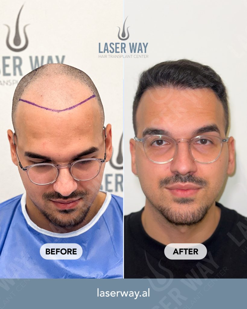 Laser Way Clinic è diventata sinonimo di qualità e affidabilità nel trapianto di capelli. Miglia