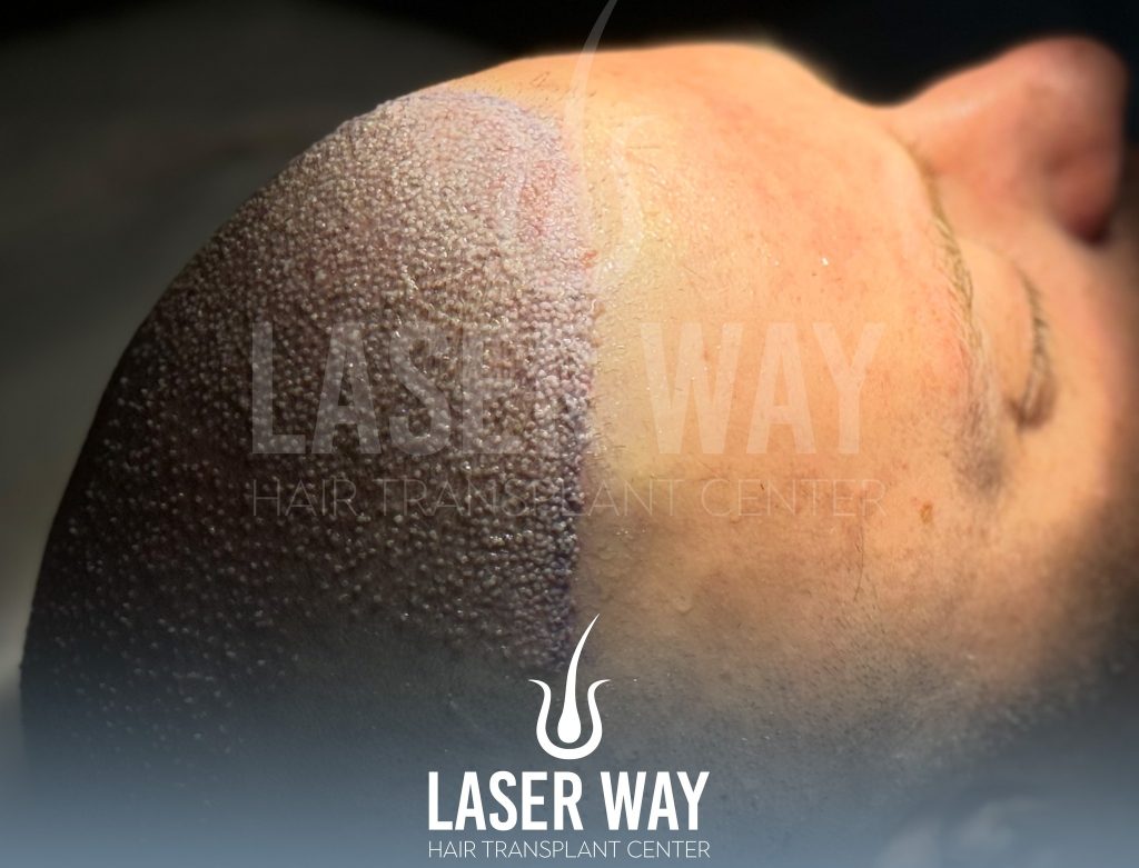 shock loss after a hair transplant
