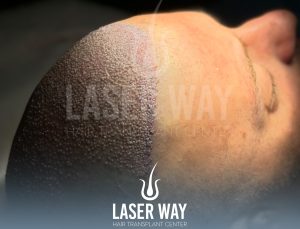 shock loss after a hair transplant